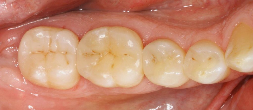 Le tecniche adesive moderne possono garantire estetica e funzione